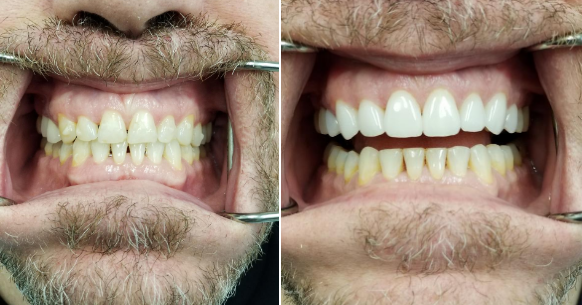 porcelain veneers