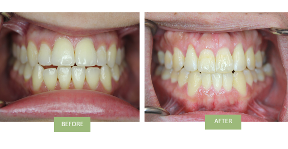 before and after invisalign