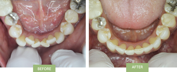 Manhattan Invisalign before & after crowded teeth