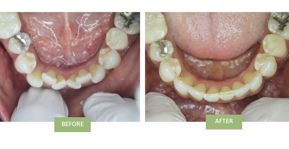 Before and after Invisalign