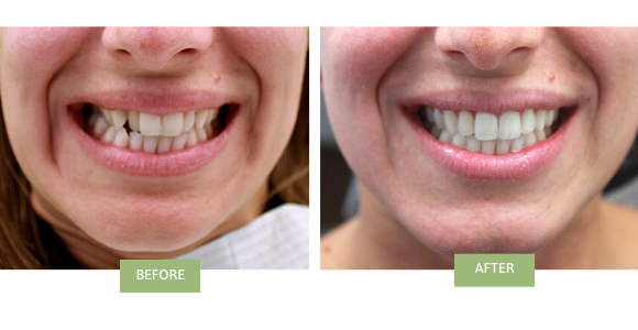 Before and after invisalign