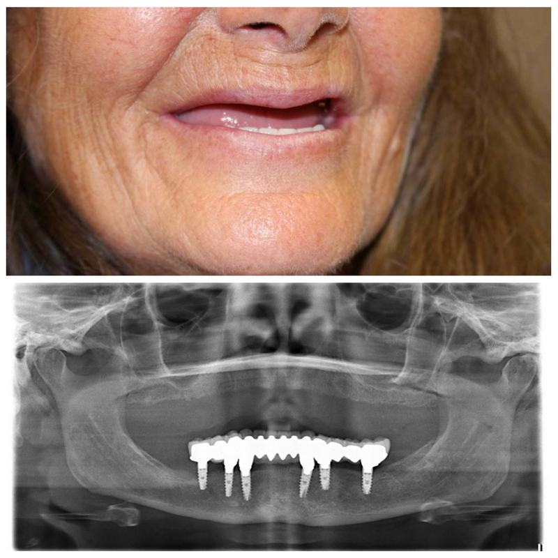 Full mouth reconstruction before and after photo