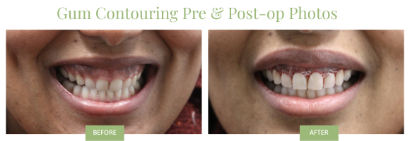 Gum Contouring with Dr. Jin Wang Before & After