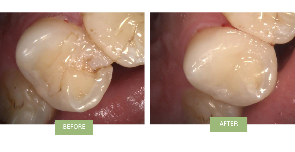 porcelain veneers before and after