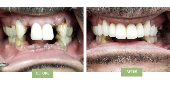 smile makeover dental bridge