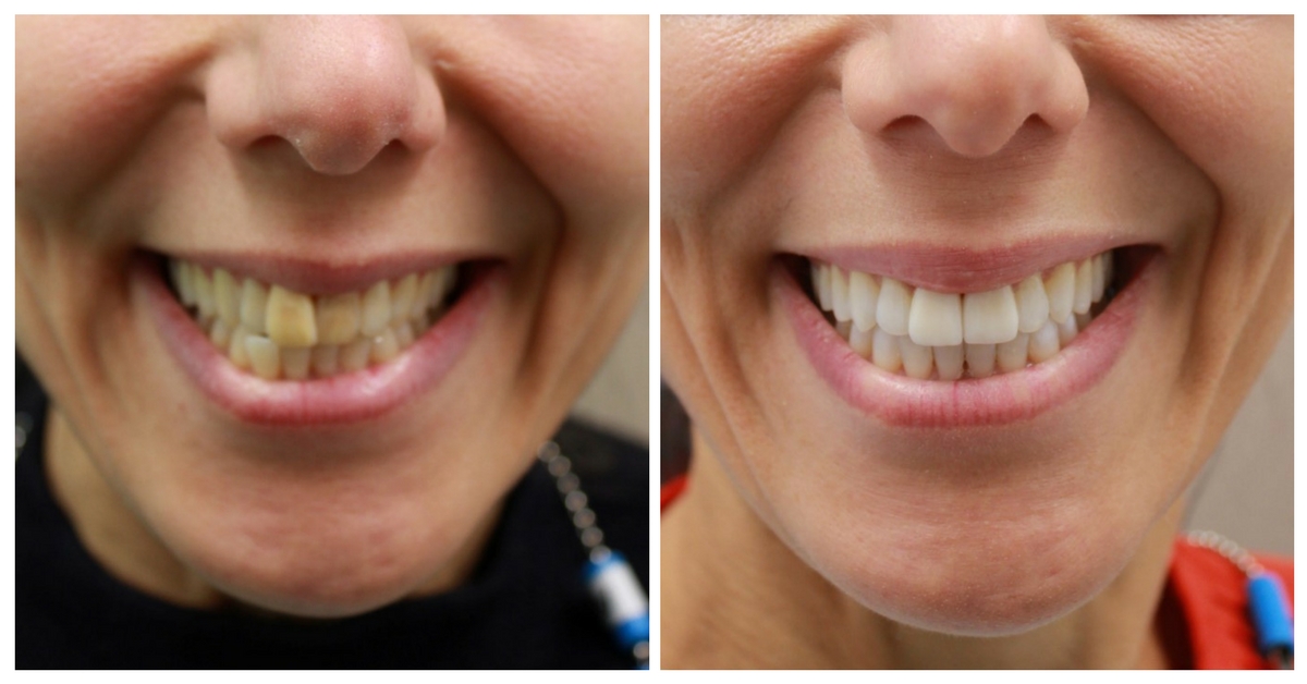 Invisalign Braces & Teeth Whitening Before & After