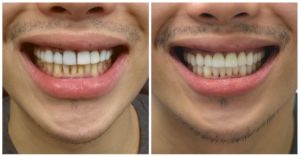 Smile Design Before & After photos by top Manhattan cosmetic dentist, completed with porcelain crowns & teeth whitening