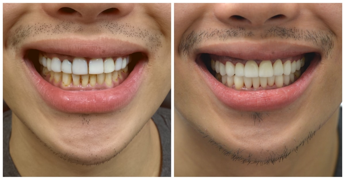 Smile Makeover NYC - Treatment Options & Cost | 209 NYC Dental