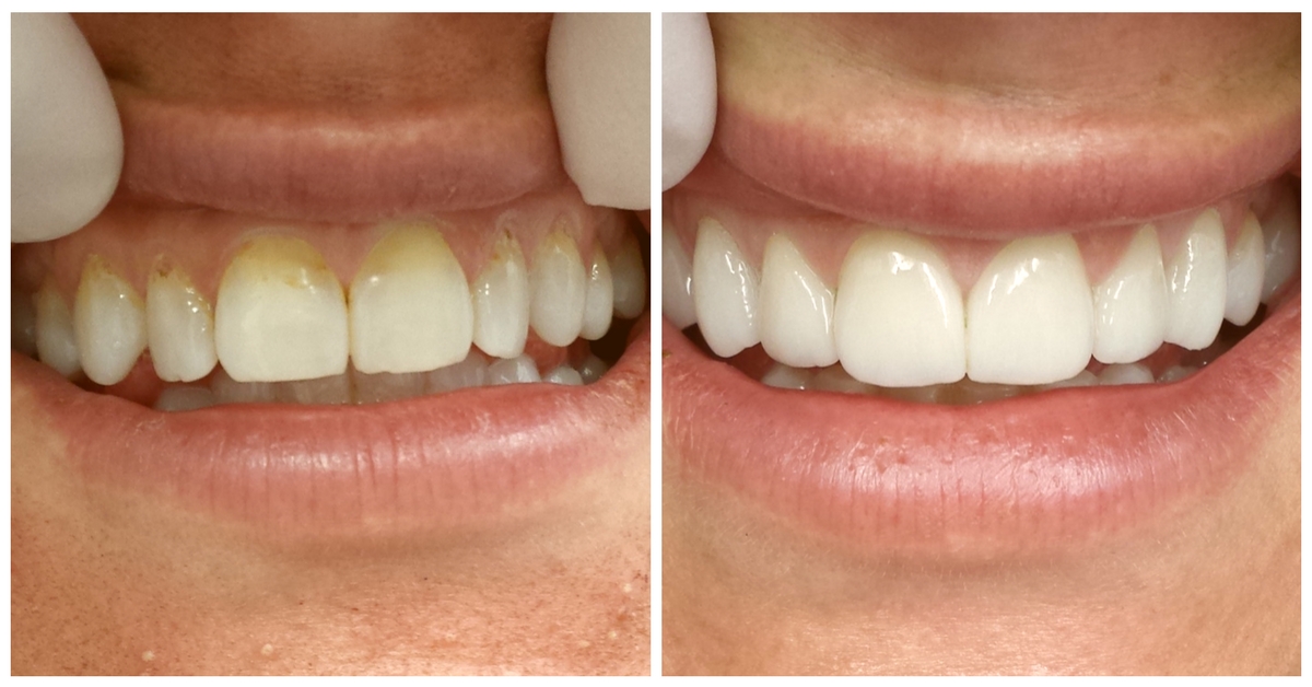NYC Porcelain Veneers Before & After - Upper due to medication induced stains