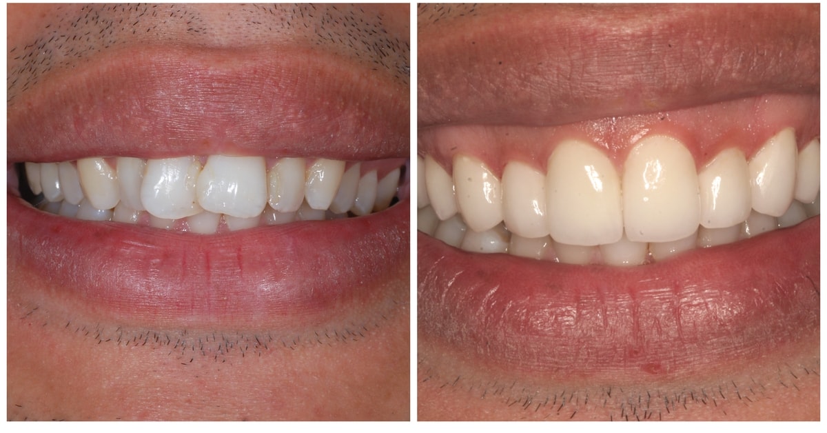 Porcelain Veneers NYC Before & After - due to crowding Upper