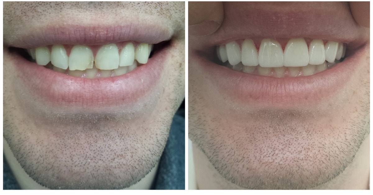 Porcelain Veneers Before & After NYC- Upper due to fracture