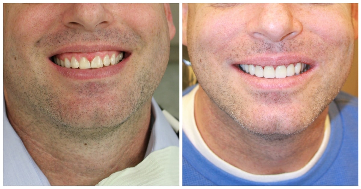 Porcelain Veneers NYC -Before & After