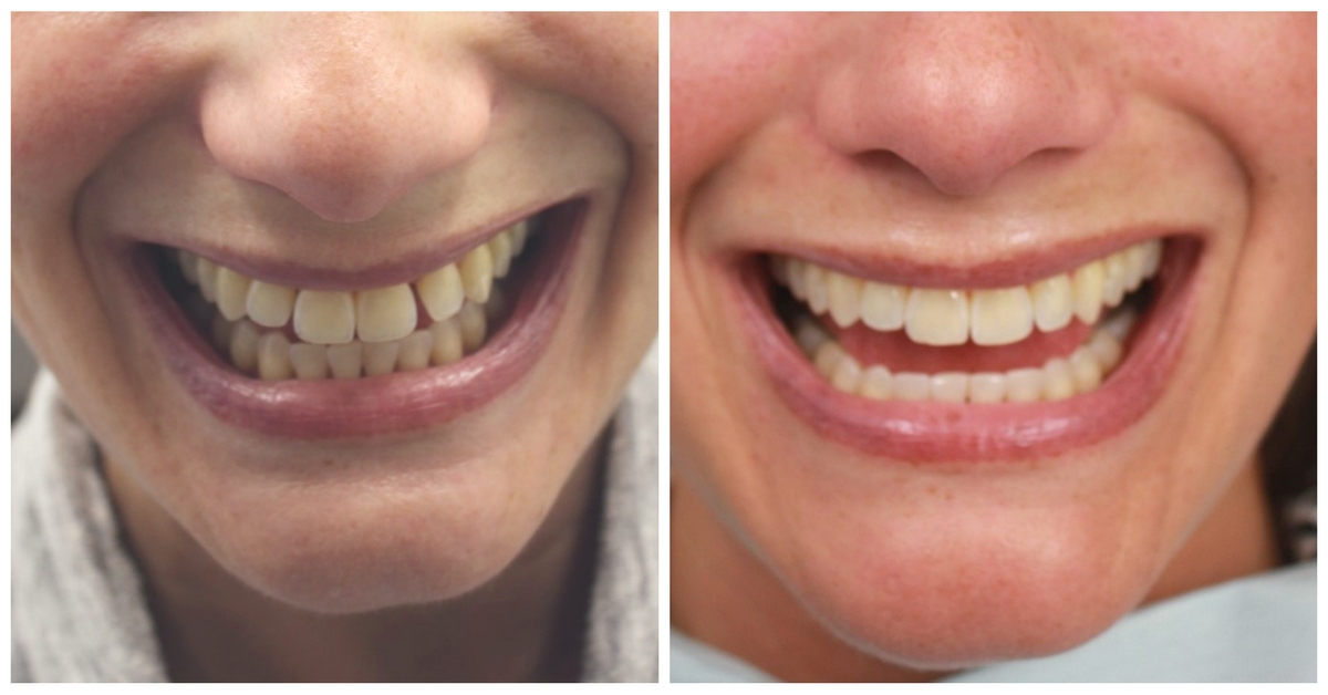 Smile Makeover Before & After by 209 NYC Dentist, completed with Invisalign