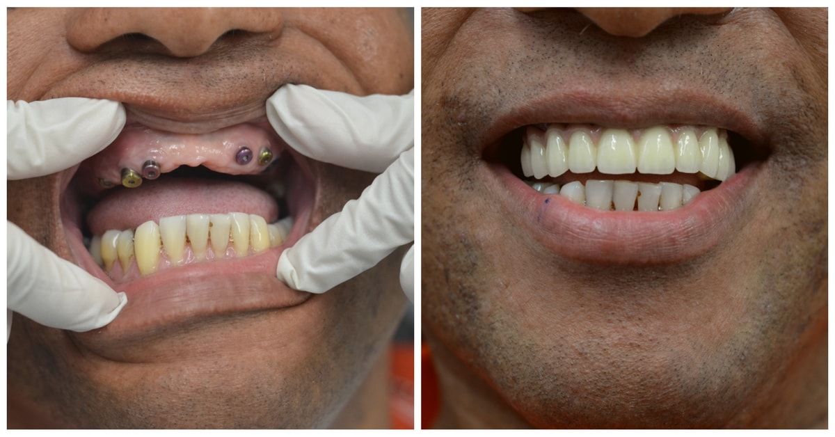 Full Mouth Dental Implants