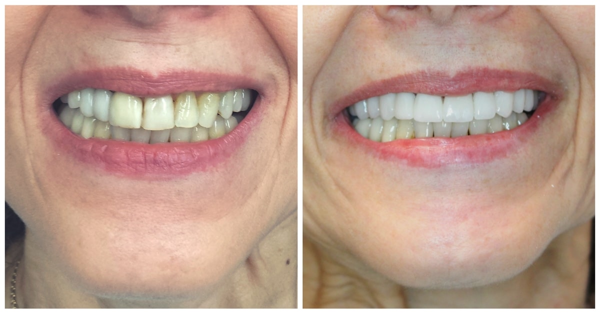 Smile Design Before & After by 209 NYC Dentist, completed with porcelain crowns top & bottom