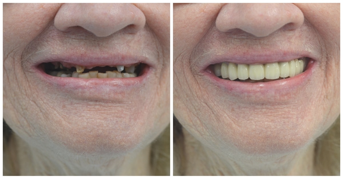 before and after smile makeover