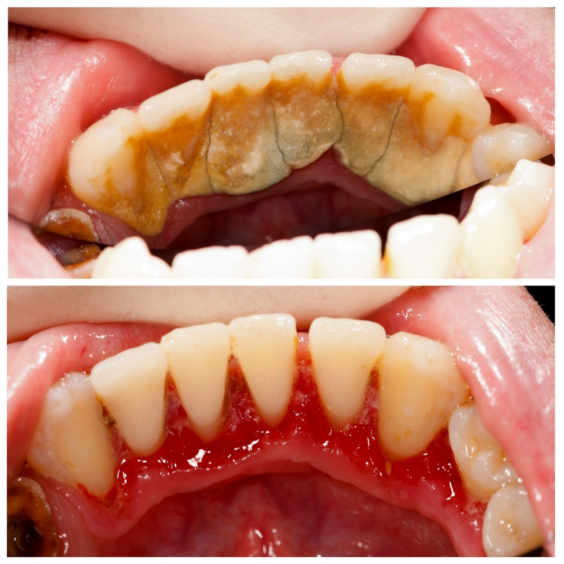 Dental teeth cleaning & Debridement Before & After photos