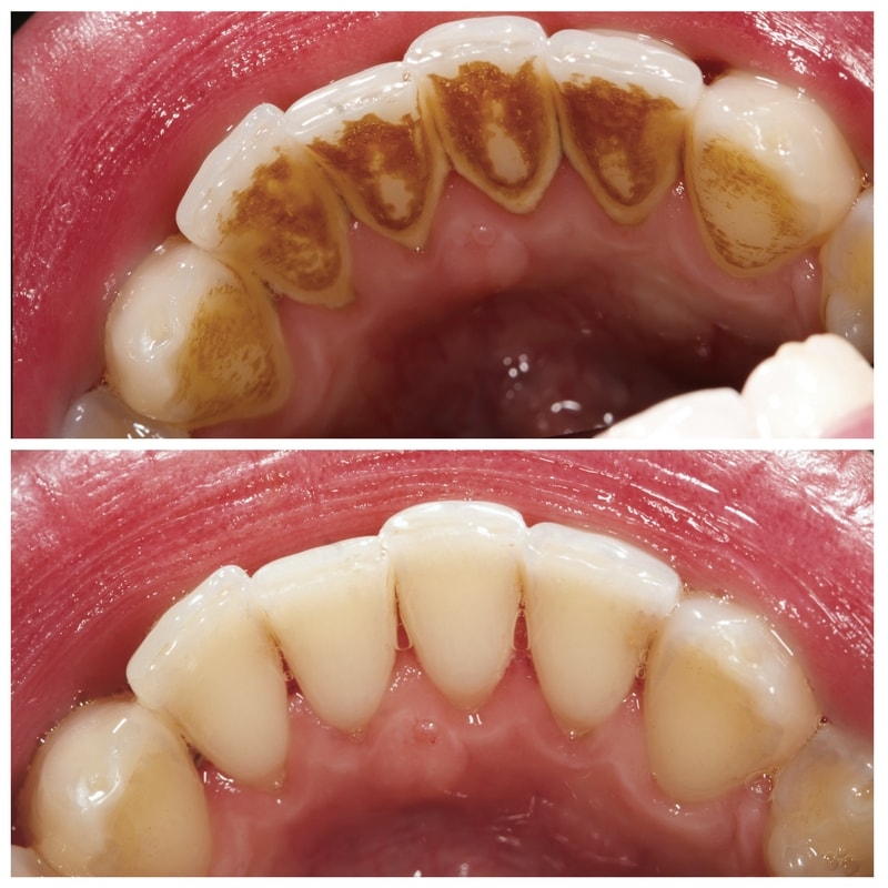 Dental teeth cleaning Before & After photos