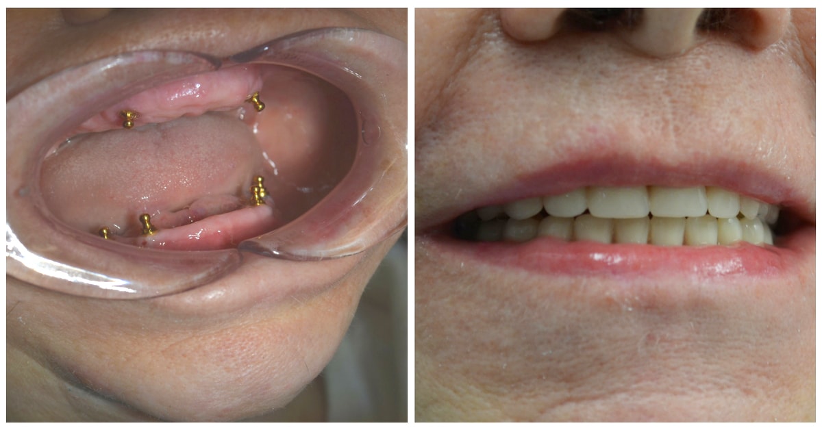 Implant supported dentures, before and after photos