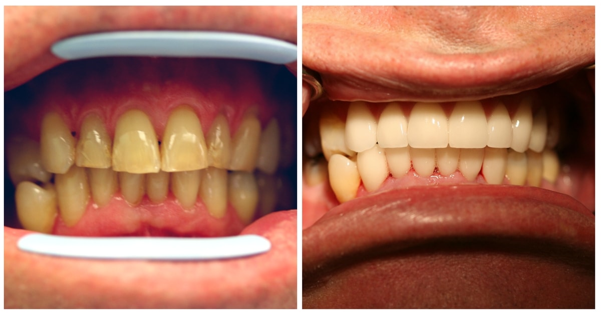 Porcelain Veneers New York - Before & After -Top & Bottom