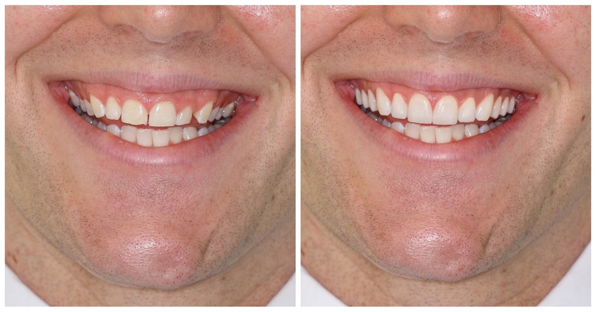 Smile Makeover Before & After by 209 NYC Dentist, completed with porcelain veneers & gum lift