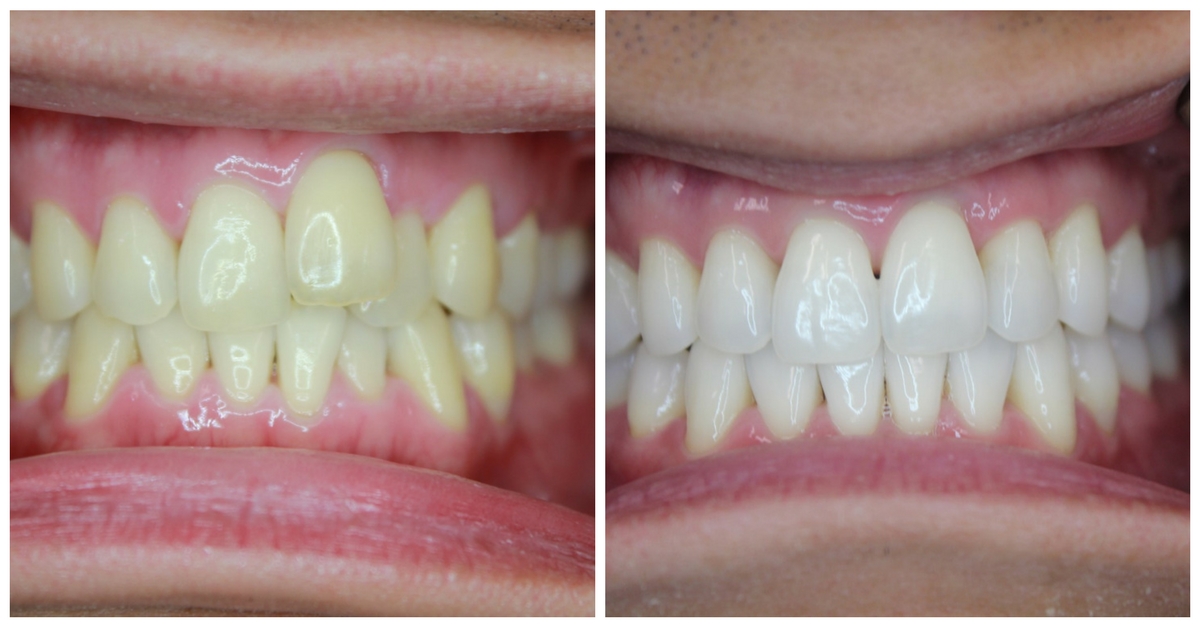 Smile Makeover Before & After by 209 NYC Dentist, completed with Invisalign and teeth whitening