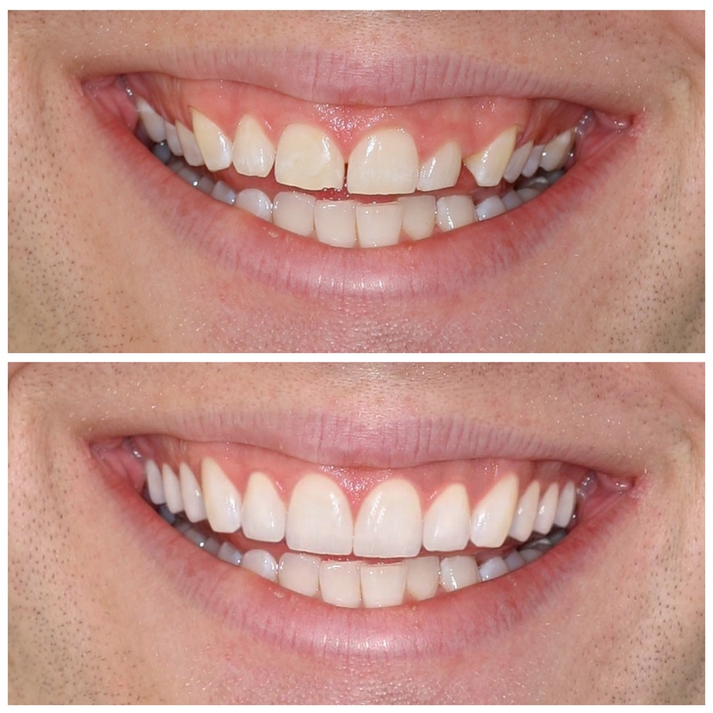 befire and after gum reshaping