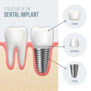 Dental implant crown connected to the dental implant by an abutment