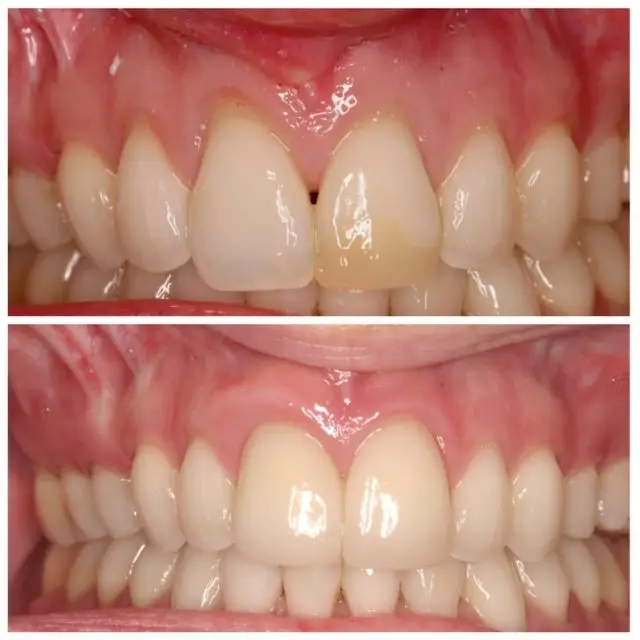 A before-and-after image of gum contouring in NYC