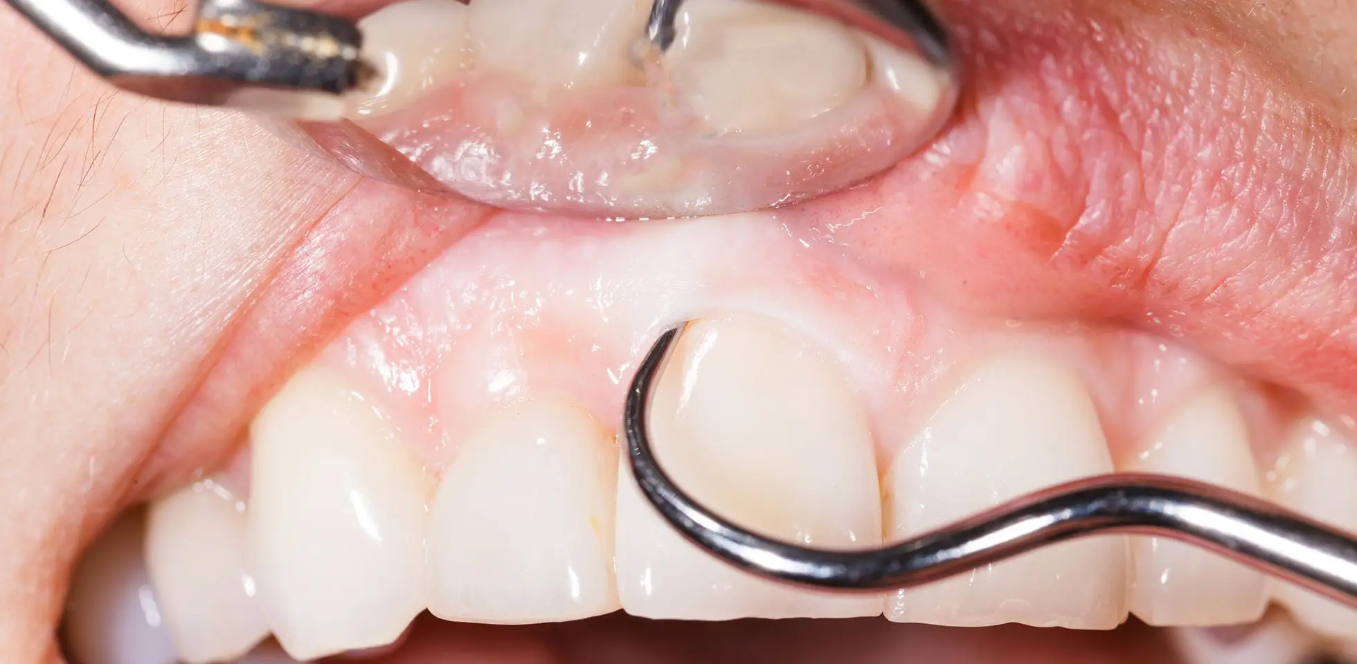 A close-up image of a dentist performing gum grafting in NYC