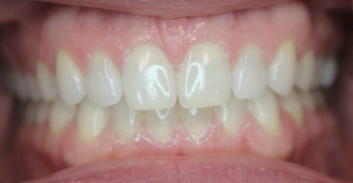 Before & after Invisalign - closed spacing between teeth