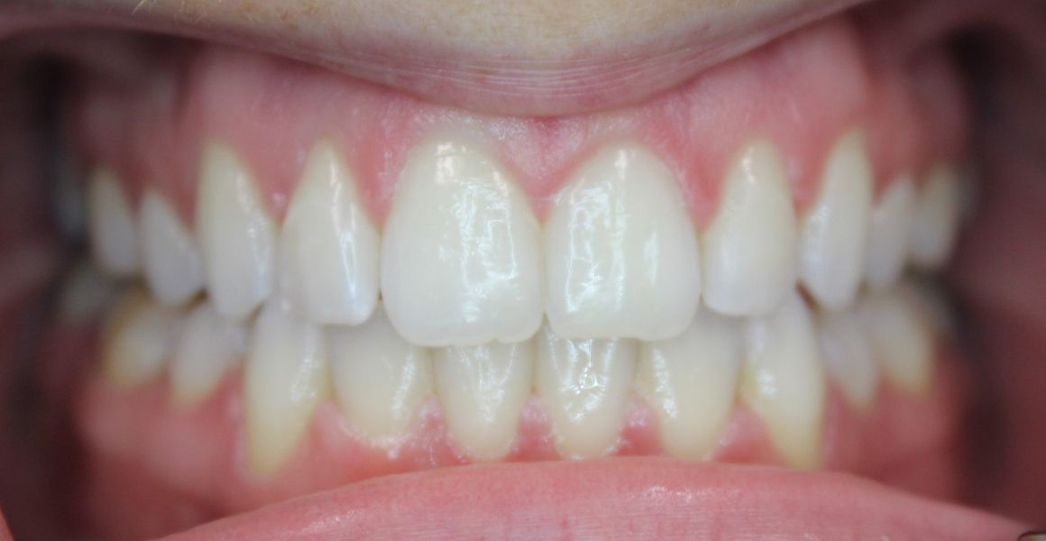Before & after Invisalign - open bite corrected