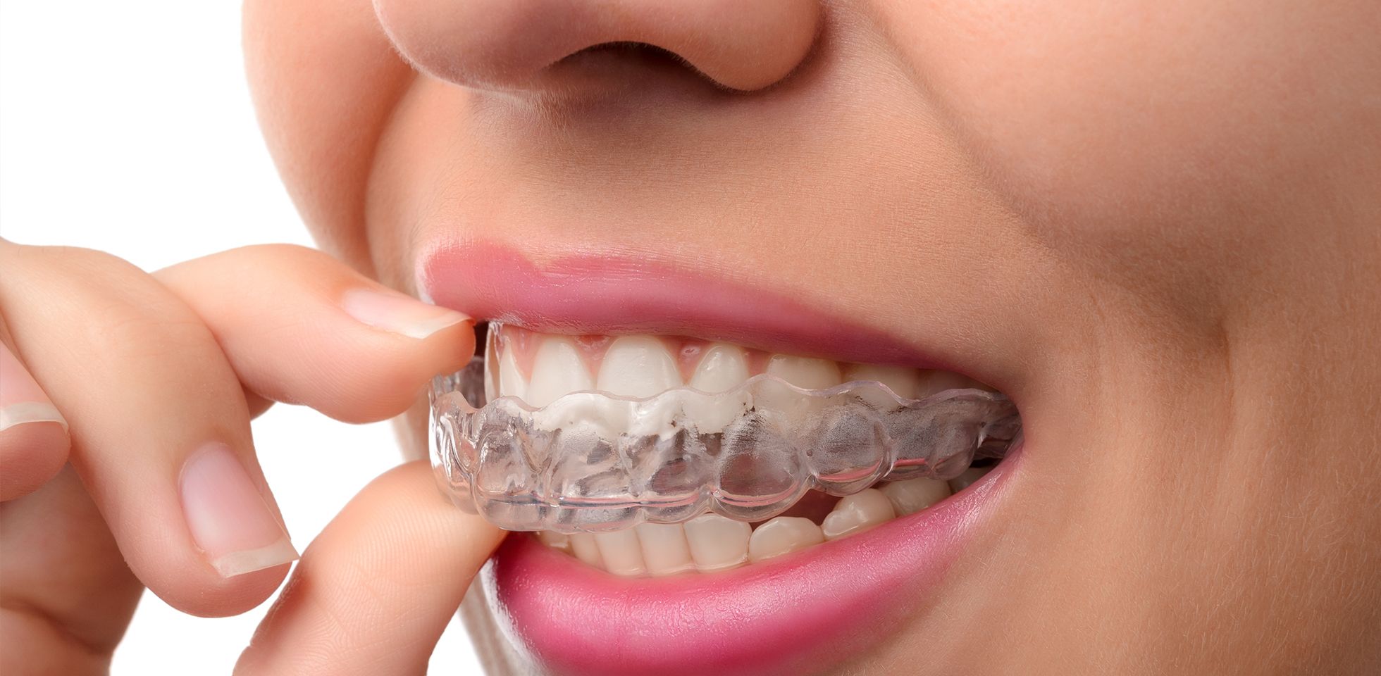 3 Affordable Dental Mouth Guards & How Much They Cost