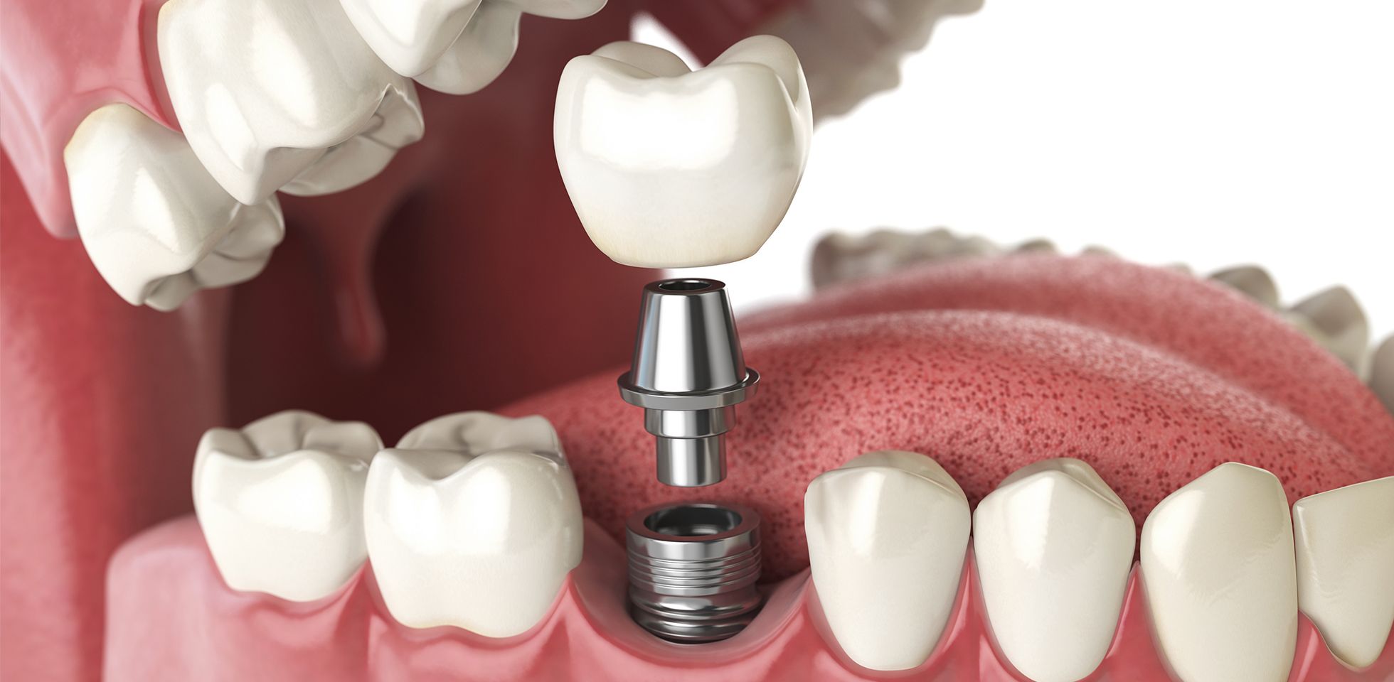 ESTEEM Dental Implants Troy, MI - Birmingham, MI - Bloomfield, MI -  Cosmetic Dentistry Institute