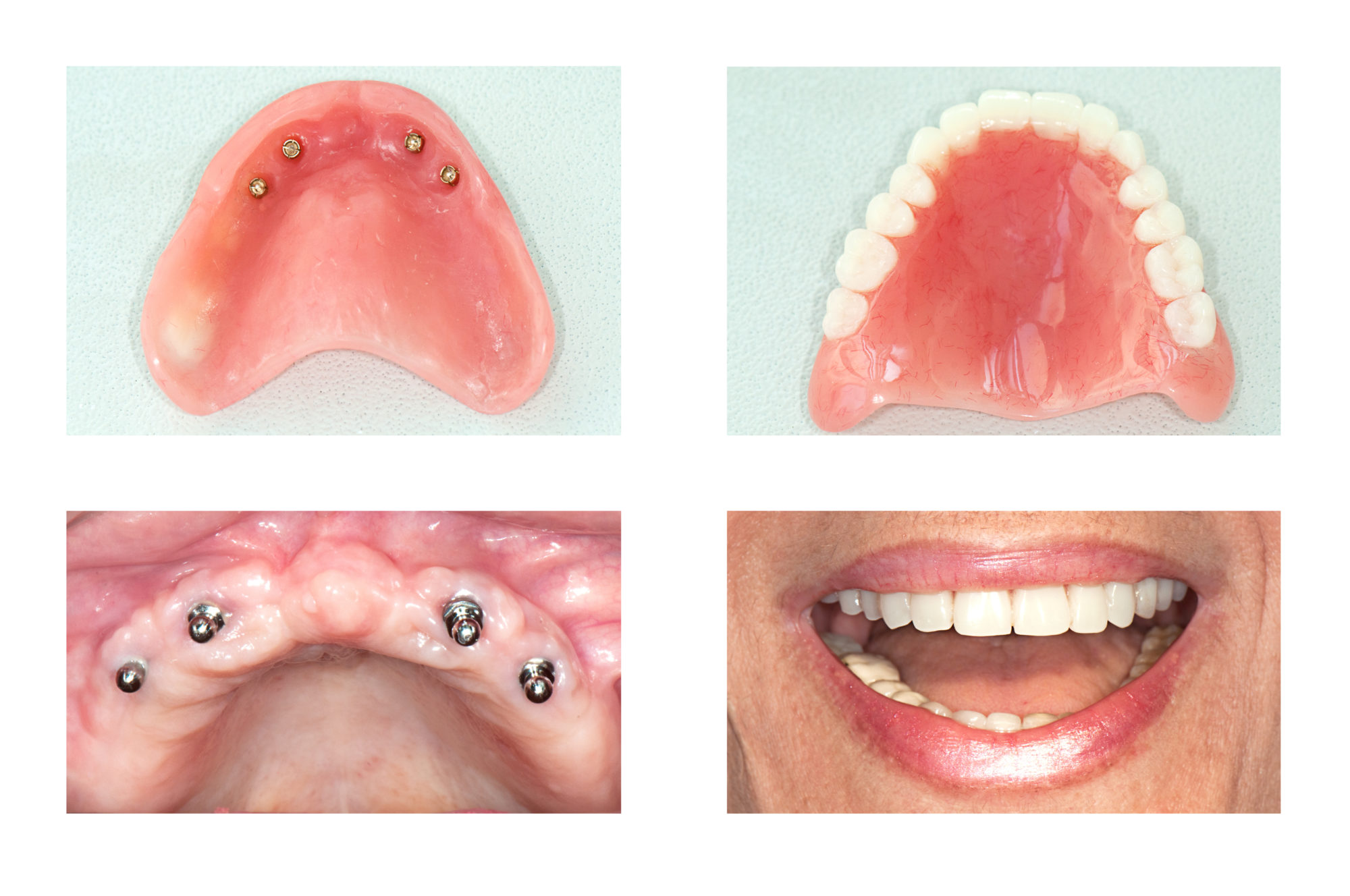 implant all on 4 dentures