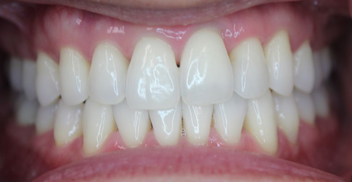 An after image of someone who received teeth whitening in NYC