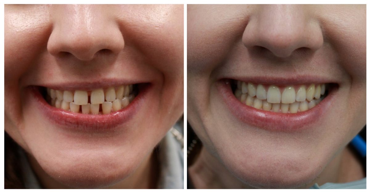 Invisalign Braces NYC patient Before & After photos spaces between teeth