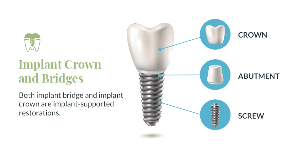 Implant Crown