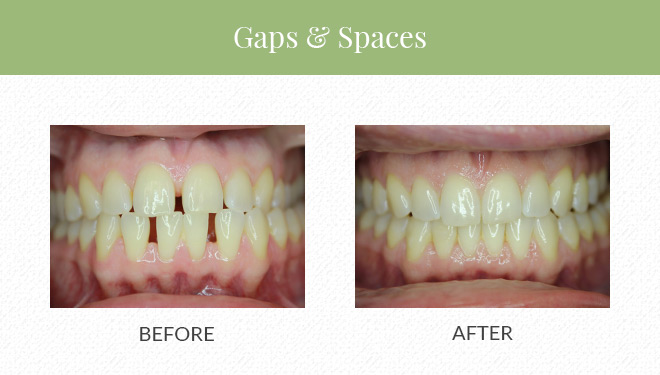 Treatment Before & After by invisalign vs clearcorrect for gaps and spaces in teeth