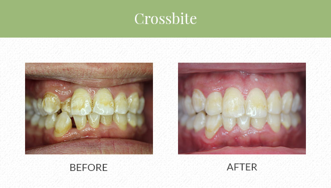 Treatment Before & After by invisalign and clear correct braces for cross bite