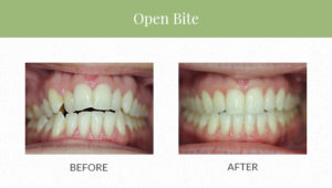 Invisalign for open bite before and after