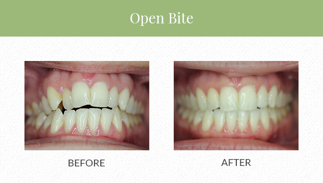 Treatment Before & After by invisalign and clear correct for open bite