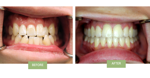 Invisalign for crowded teeth - before & after