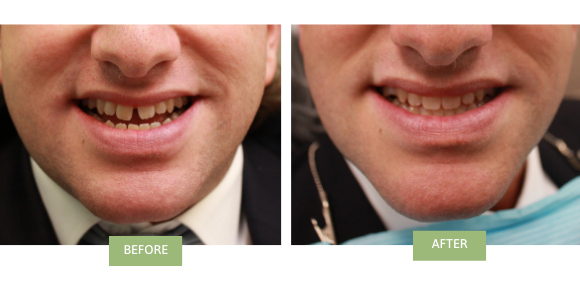 Before and after invisalign for underbite