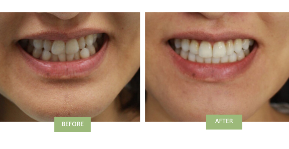 Before and after invisalign for crowded teeth