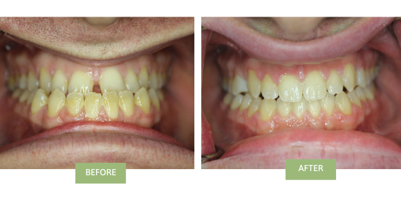 Before and after invisalign for underbite