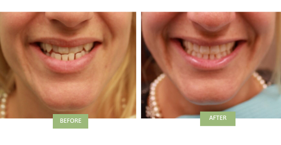 Before and after invisalign for underbite