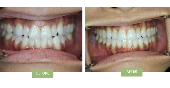 invisalign for crowded teeth