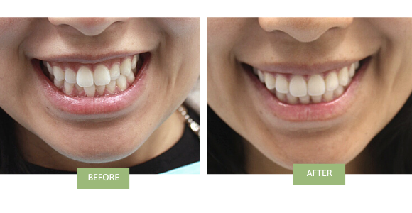 invisalign for crowded teeth