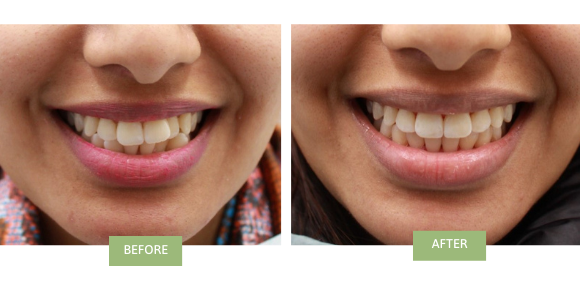 A before-and-after image of Invisalign for crowded teeth